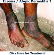 ECZEMA / Atopic DERMATITIS Treatment in Pondicherry 