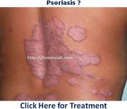 Psoriasis Treatment in Pondicherry